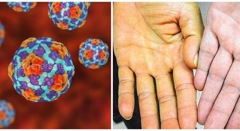Гепатит А (хвороба Боткіна) - забута хвороба розвинених країн, проте актуальна у країнах, що розвиваються
