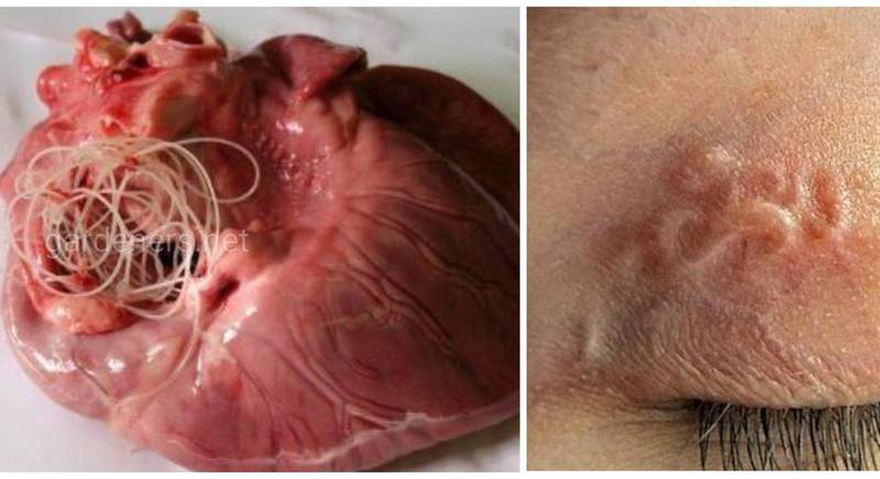 Dirofilaria - "серцевий глист" собак та причина дірофіляріозу у людини