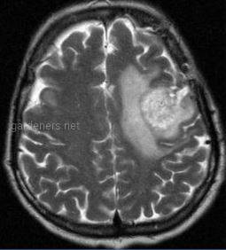 Цистицеркоз мозга. Рентгеновский снимок
