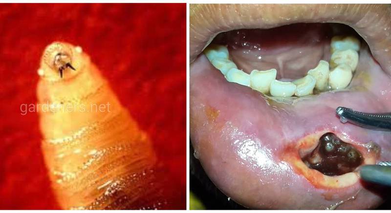 Оральный миаз - редкое паразитарное заболевание человека, причина которого паразитирование личинок двукрылых