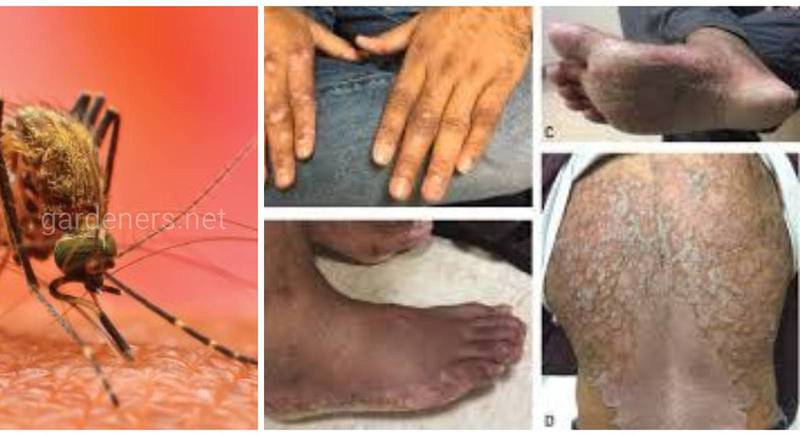 Лихоманка чикунгунья - вірусне захворювання, яке передається через укуси комарів від хворої людини та мавп