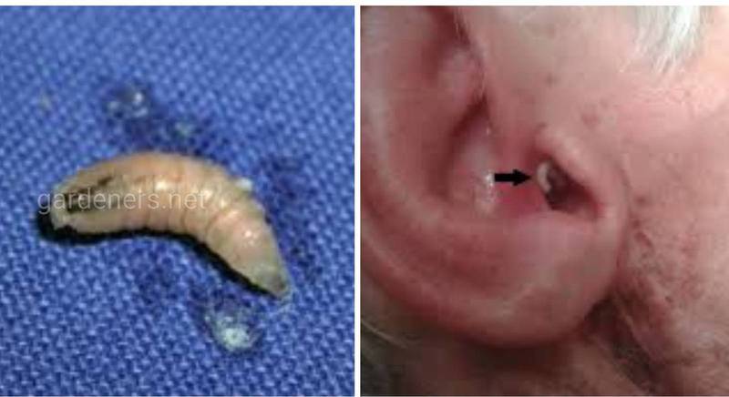Ушной миаз - отомиаз - заболевание человека, связанное с паразитированием личинок короткоусых двукрылых насекомых