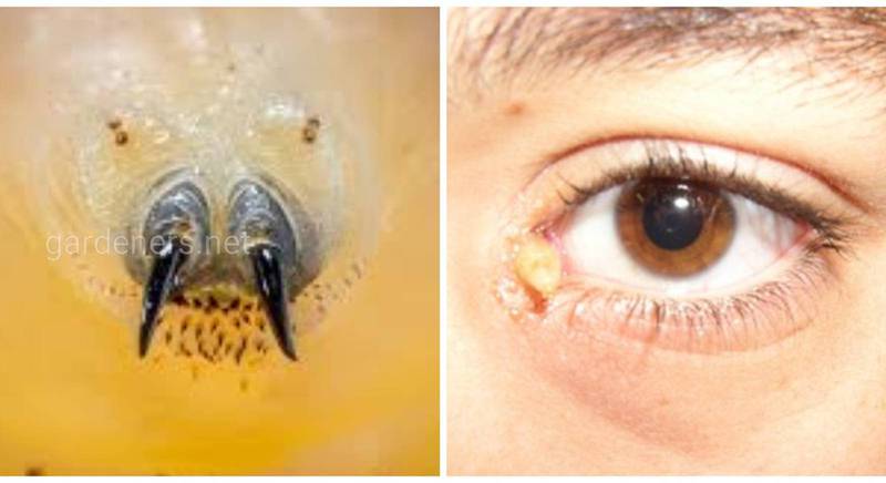 Глазной миаз - паразитарное заболевание, провоцируемое личинками двукрылых насекомых